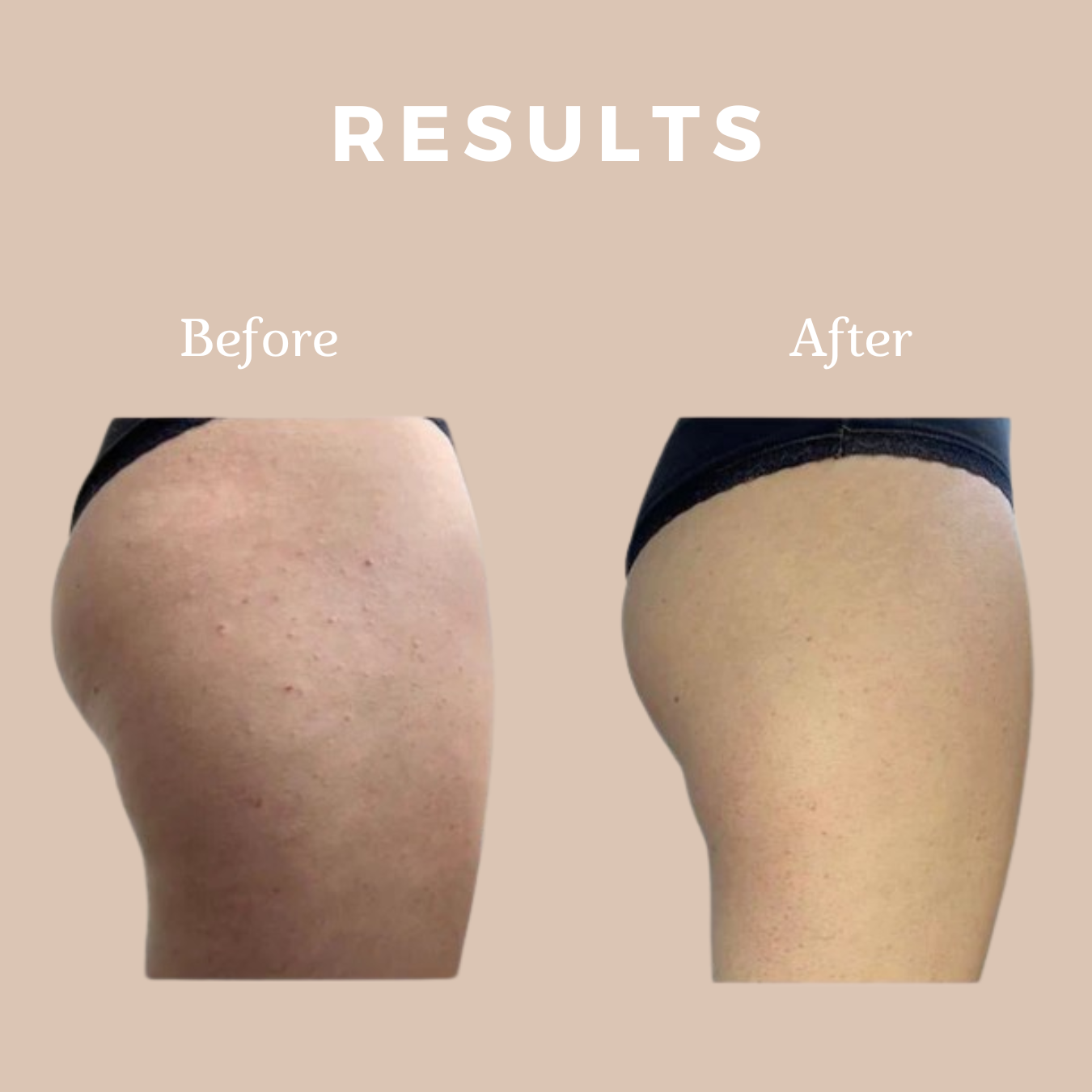 Before and after of bumpy to smooth leg skin using exfoliating mitt, results shown at top